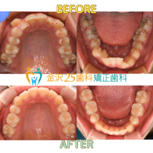 ワイヤー矯正症例
