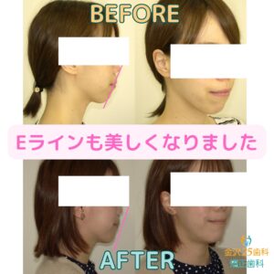 ワイヤー矯正症例