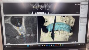 １２月インプラントオペ